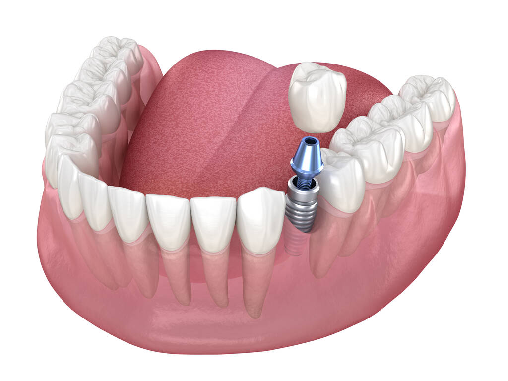 Best dental implants in Perth WA Affordable dental implants in Perth