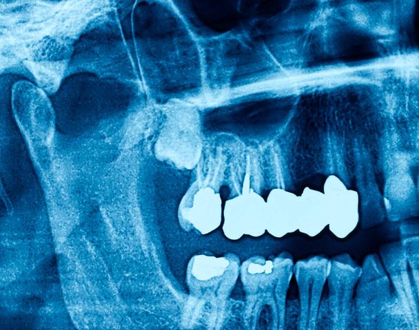 Average Cost Of Wisdom Tooth Removal Joondalup